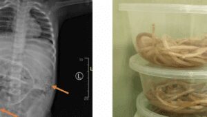 Perut Balita Penuh Cacing, Infeksi Cacing Gelang, Kasus Viral Jember, Kesehatan Anak, Sanitasi, Ascaris lumbricoides, Pencegahan Parasit