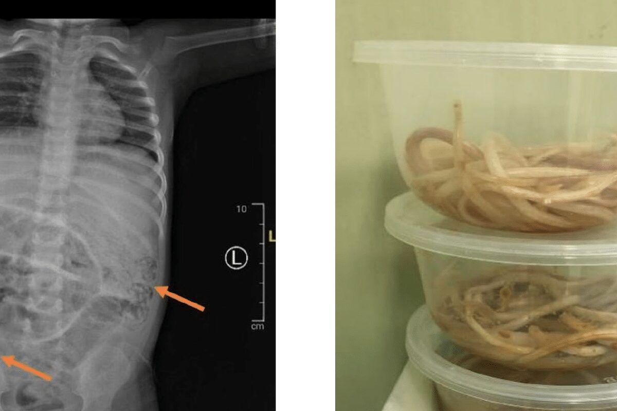 Perut Balita Penuh Cacing, Infeksi Cacing Gelang, Kasus Viral Jember, Kesehatan Anak, Sanitasi, Ascaris lumbricoides, Pencegahan Parasit