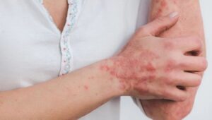 gejala autoimun adalah, penyakit autoimun, lupus, rheumatoid arthritis, tiroiditis, kesehatan, deteksi dini, sistem kekebalan, nyeri sendi