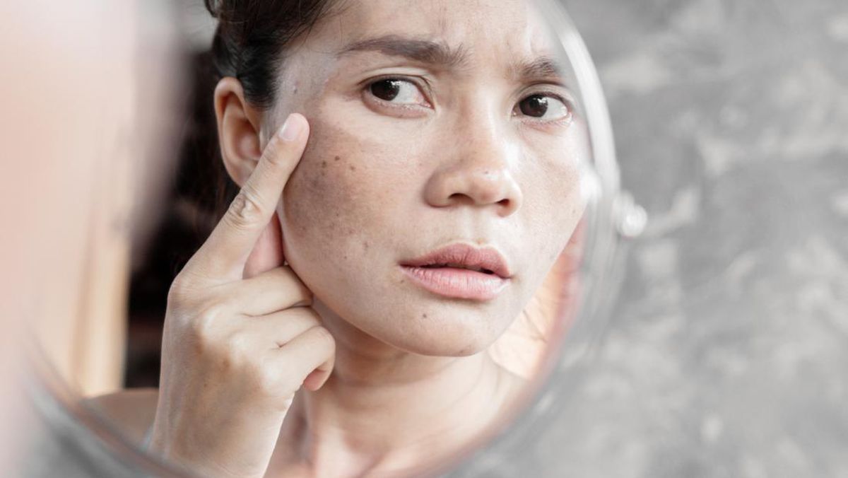 flek pada wajah, hiperpigmentasi, perawatan kulit, skincare, kulit cerah, sunscreen, niacinamide, laser pico, vitamin C