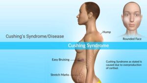Cushing sindrom, hormon kortisol, penyakit endokrin, tumor pituitari, kortikosteroid, gejala Cushing, diagnosis Cushing, pengobatan Cushing, kesehatan hormon
