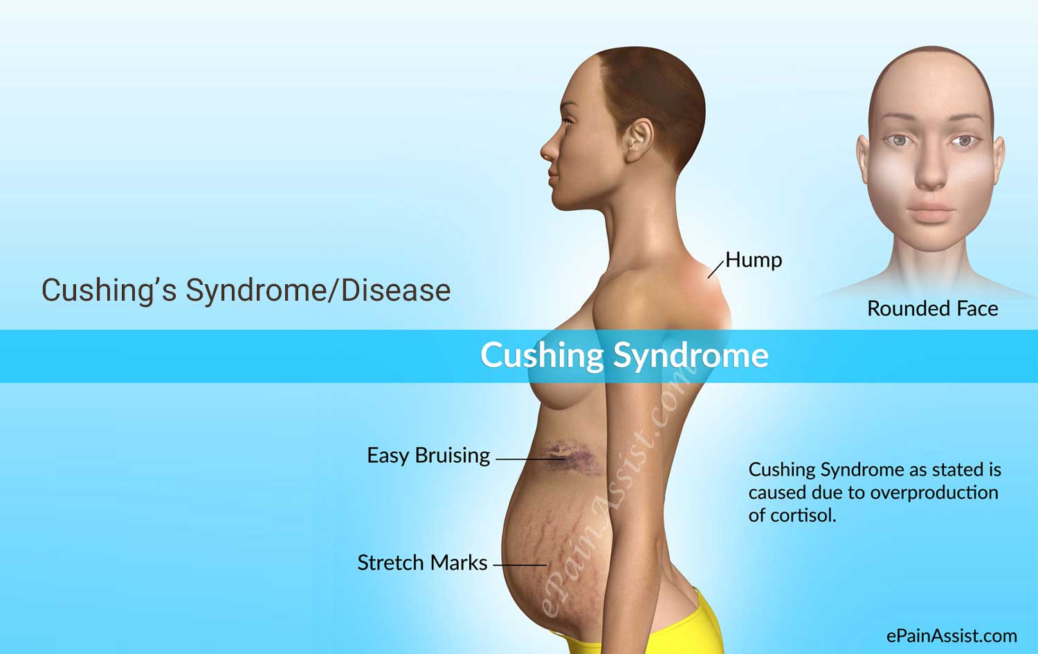 Cushing sindrom, hormon kortisol, penyakit endokrin, tumor pituitari, kortikosteroid, gejala Cushing, diagnosis Cushing, pengobatan Cushing, kesehatan hormon