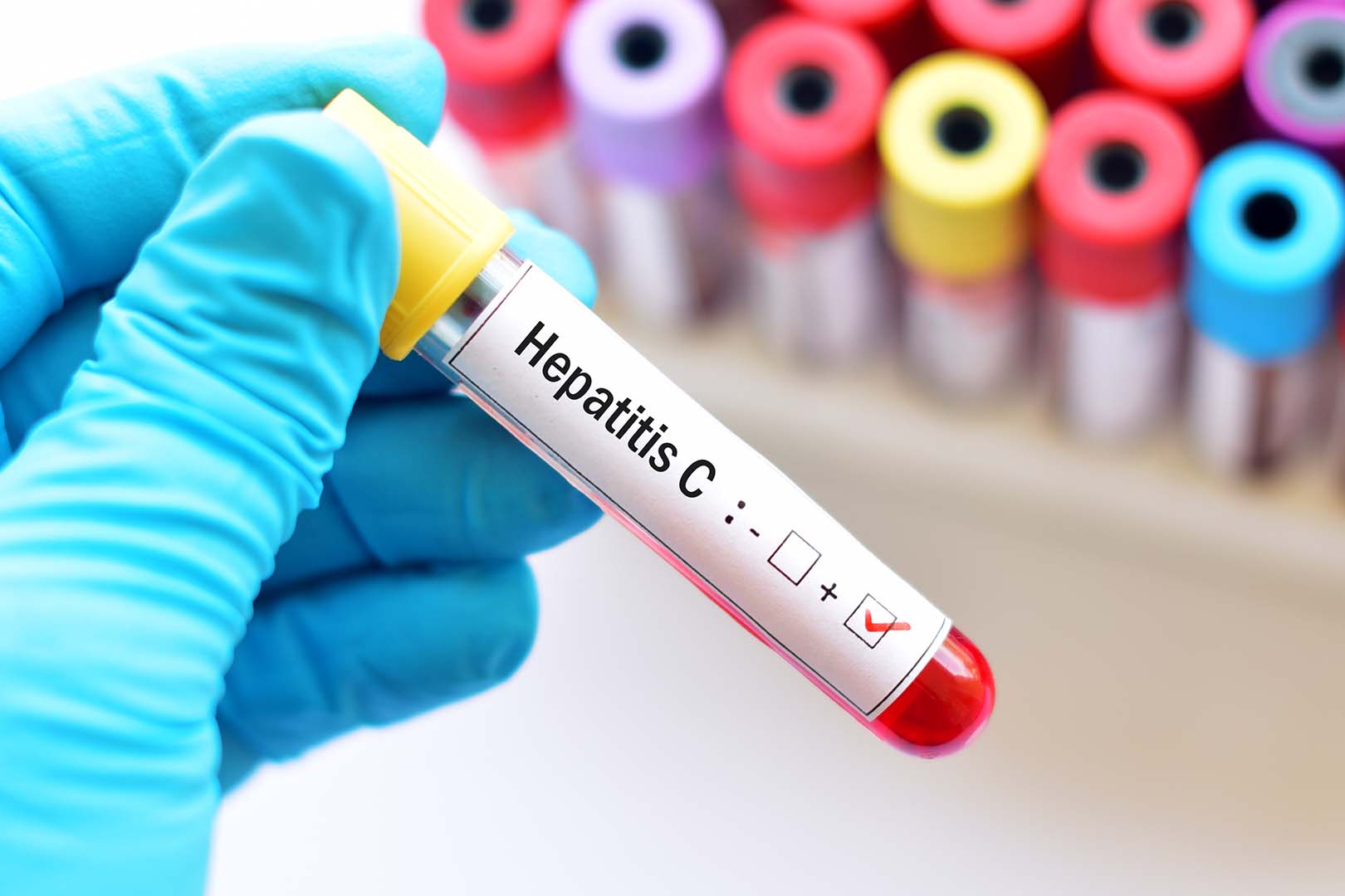 pengobatan hepatitis C, hepatitis C, virus hepatitis C, obat DAA, sofosbuvir, velpatasvir, kesehatan hati, deteksi dini, skrining hepatitis