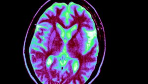 Penemuan gula otak mengungkapkan petunjuk baru tentang Alzheimer’s