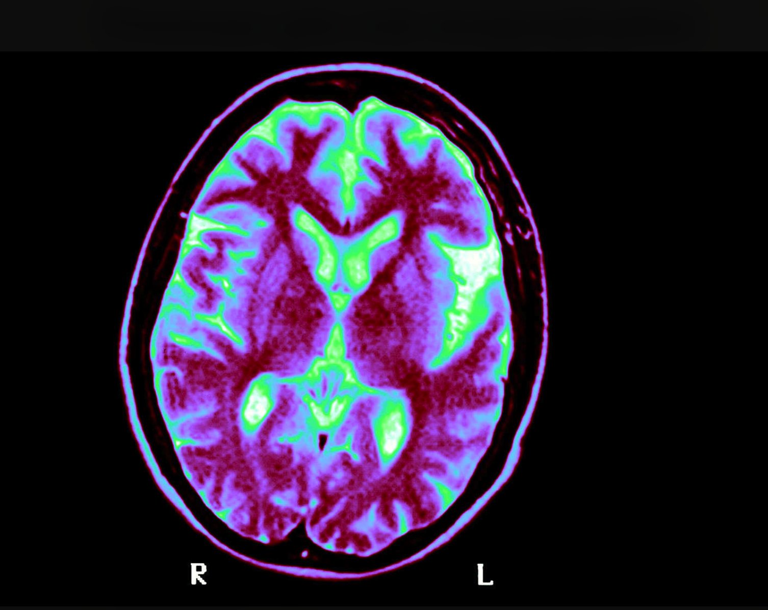 Penemuan gula otak mengungkapkan petunjuk baru tentang Alzheimer’s