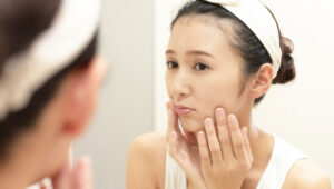 perawatan melasma, melasma, kulit cerah, skincare, sunscreen, laser terapi, chemical peel, tranexamic acid, dermatologi