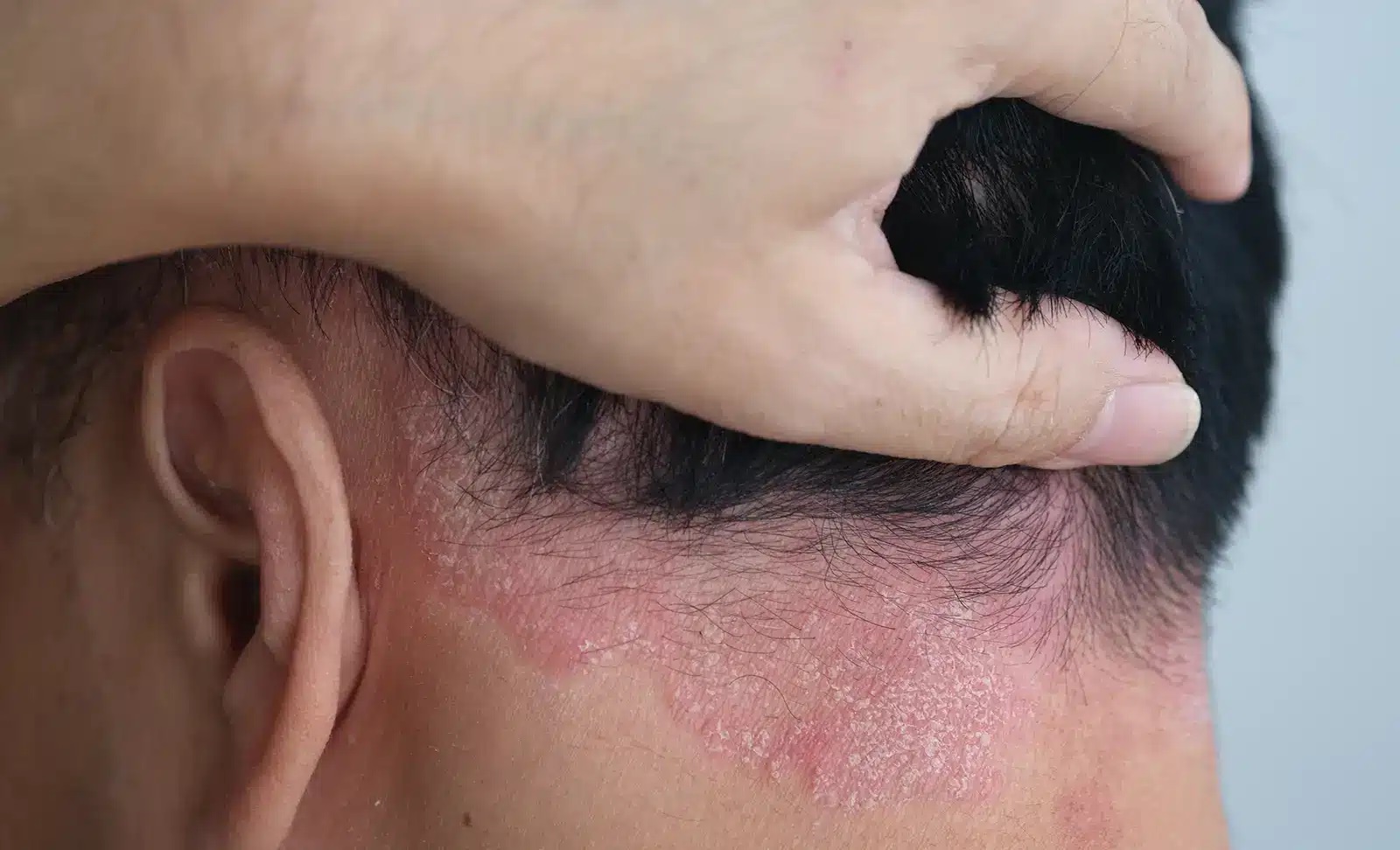 definisi scalp adalah